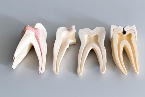Root Canal Misconceptions