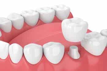 Crown - Urgent Dental care in Kelowna