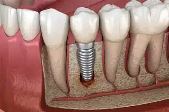 implants, Dental implant in Kelowna