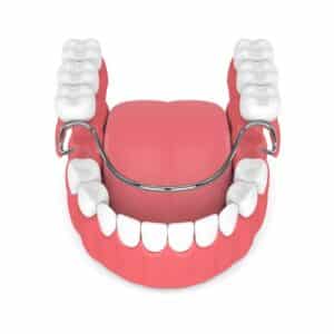 partial dentures for front teeth