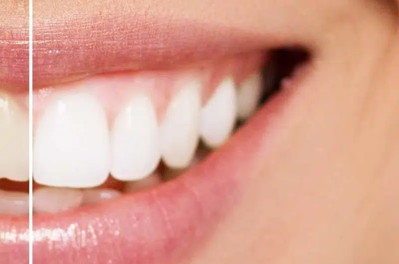 teeth Whitening in ner category