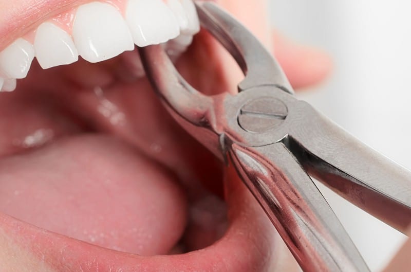 tooth extraction in orthodontics
