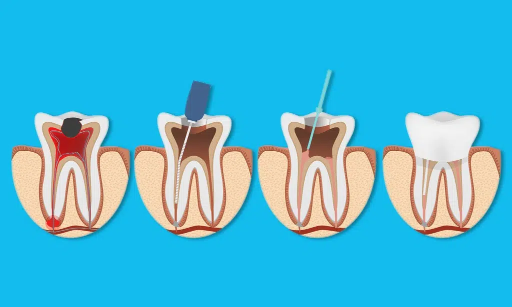what is root canal, dental clinic in kelowna