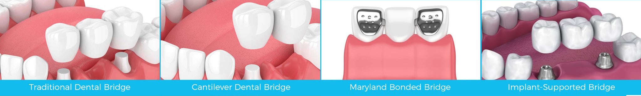 2 types of dental bridges