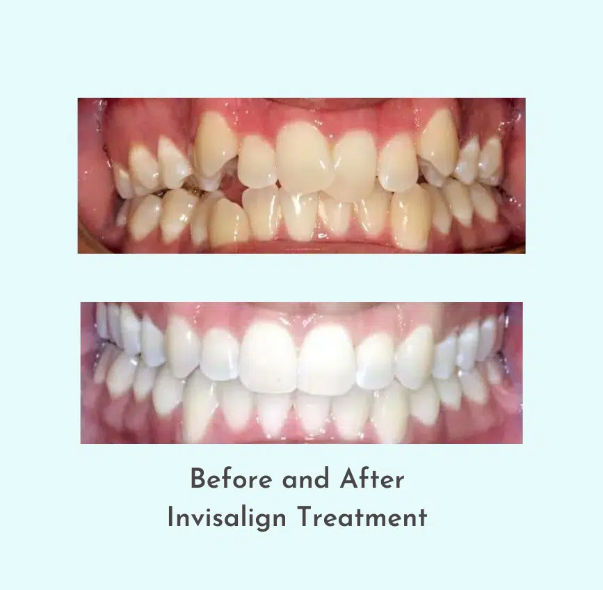 Before and After Invisalign Treatment